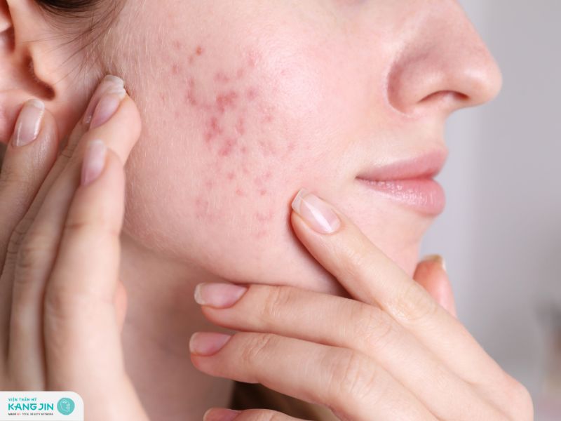 vết thâm mụn có tự hết không