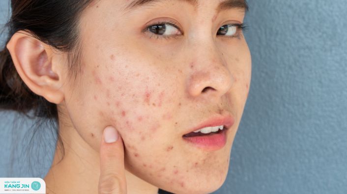 vết thâm mụn có tự hết không