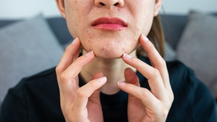 Các bước chăm sóc da dầu mụn hàng ngày không thể thiếu