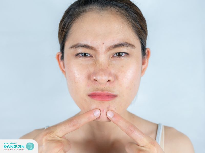 Các bước chăm sóc da dầu mụn 