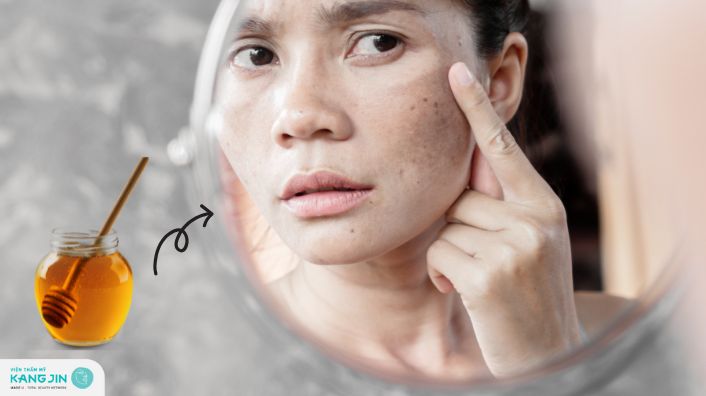 7 cách trị nám tàn nhang tại nhà bằng mật ong nhiều người đã áp dụng