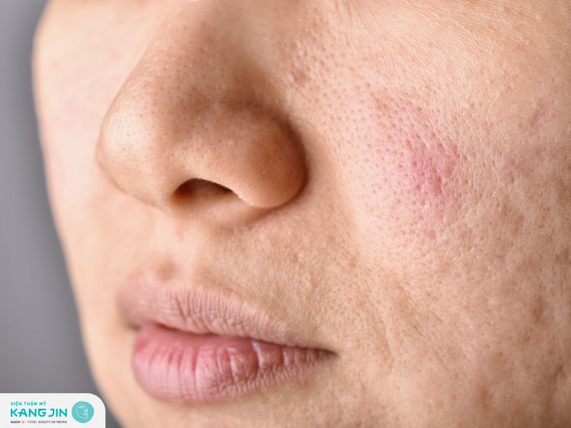Lỗ chân lông mẩn đỏ gây cảm giác khó chịu