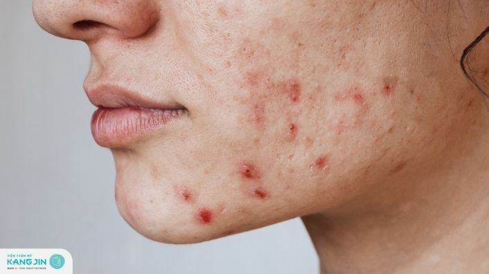 Nguyên nhân và cách khắc phục lỗ chân lông bị đỏ