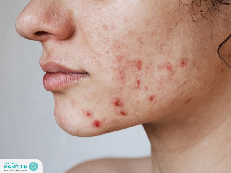 Lỗ chân lông bị đỏ: Nguyên nhân, dấu hiệu nhận biết và cách điều trị