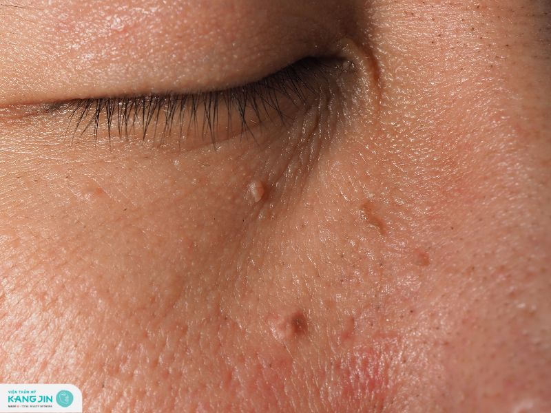 mụn đá ở mũi