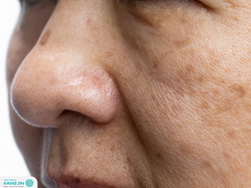 nám có trị tận gốc được không