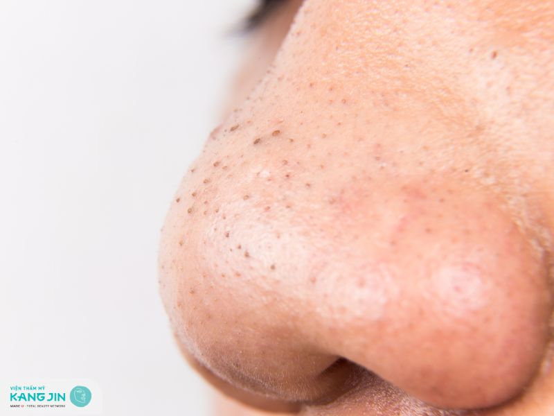 rau diếp cá có trị mụn đầu đen không