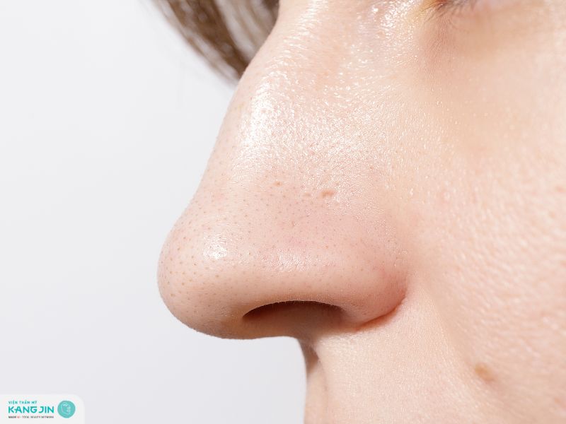 trị mụn đầu đen ở mũi bằng chanh