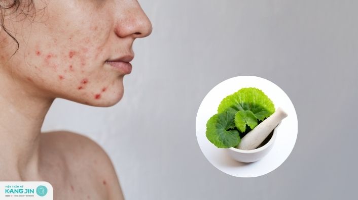 Cách trị mụn nội tiết bằng rau má tận gốc và tiết kiệm