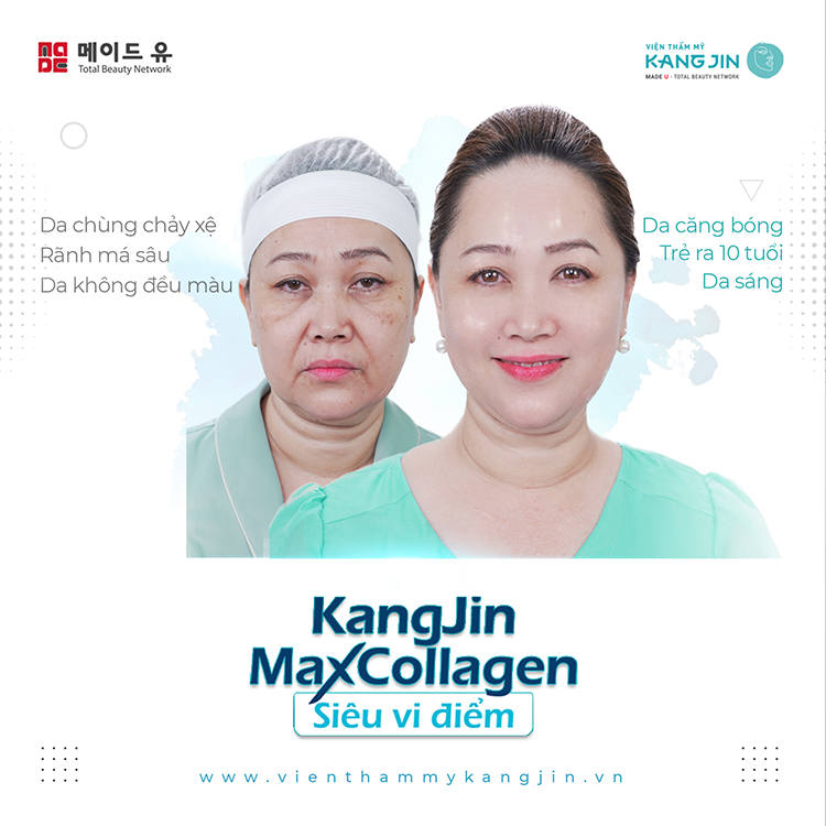 Kết quả trẻ hóa thực tế của khách hàng tại thẩm mỹ KangJin Kết quả trẻ hóa thực tế của khách hàng tại thẩm mỹ KangJin