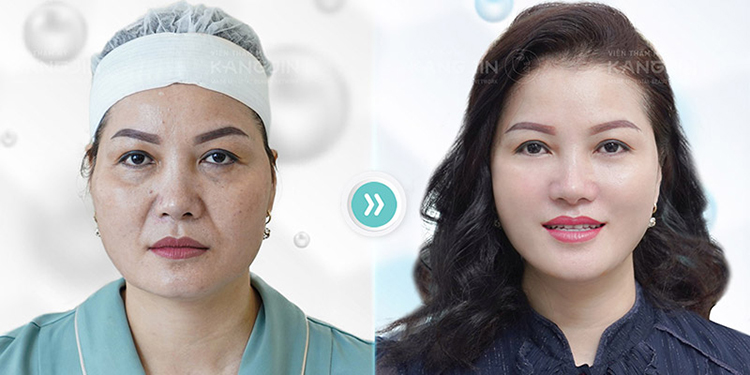 Hàng ngàn khách hàng trẻ hóa thành công