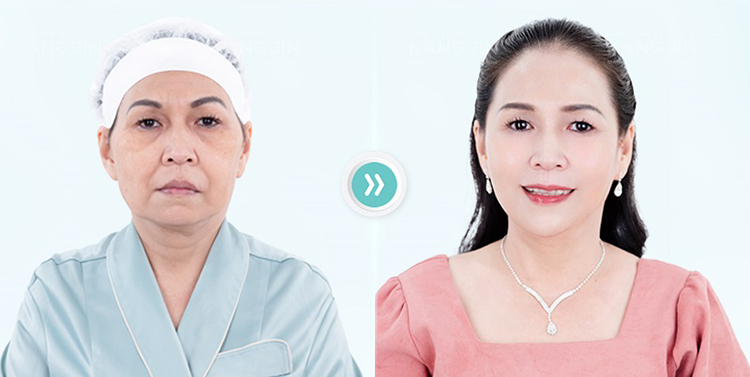 Hàng ngàn khách hàng trẻ hóa thành công