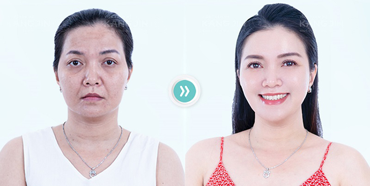 Hàng ngàn khách hàng trẻ hóa thành công