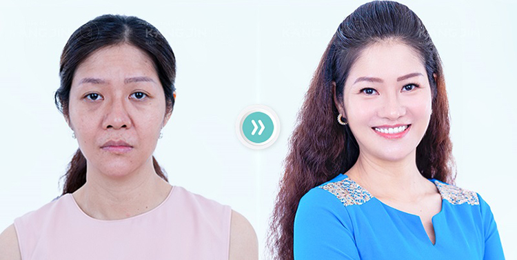 Hàng ngàn khách hàng trẻ hóa thành công