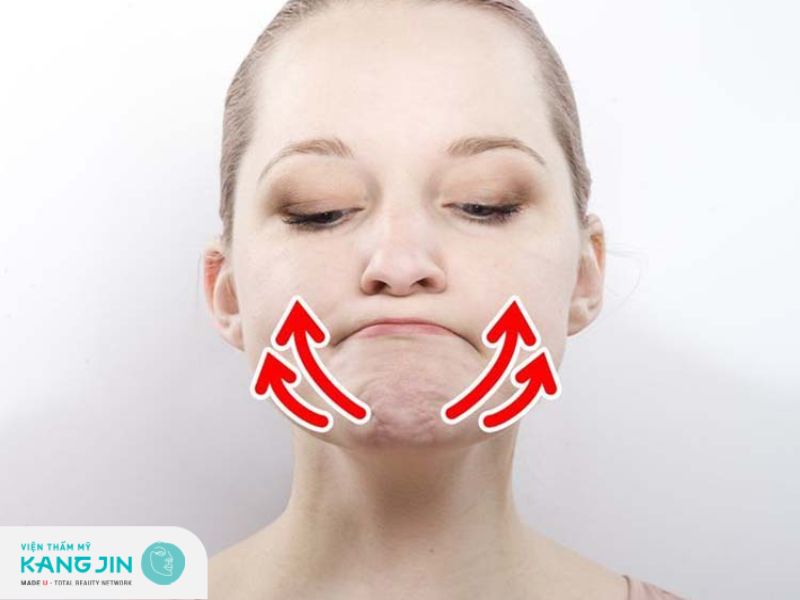 nâng cơ vùng cằm