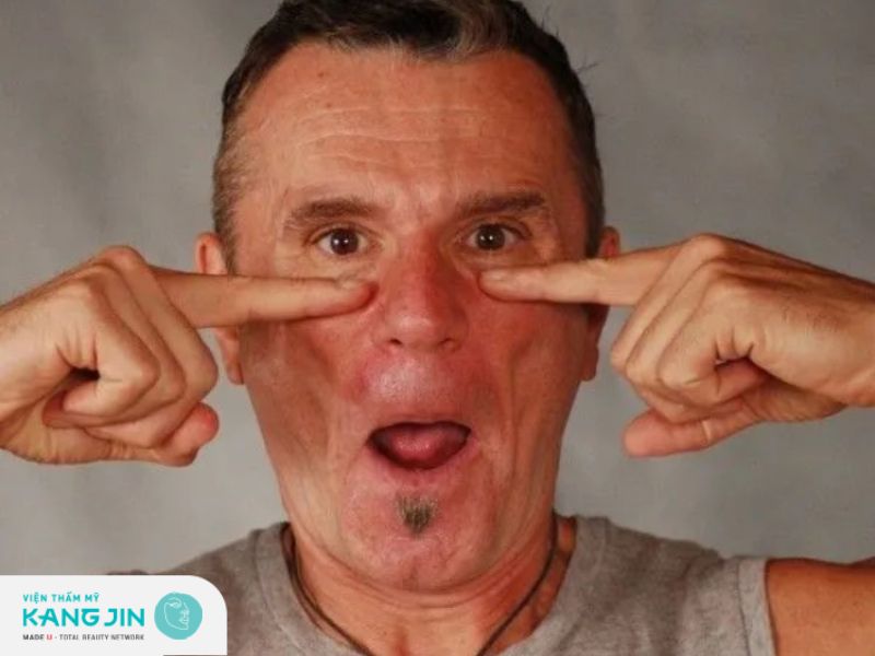 nâng cơ mặt chảy xệ vùng má