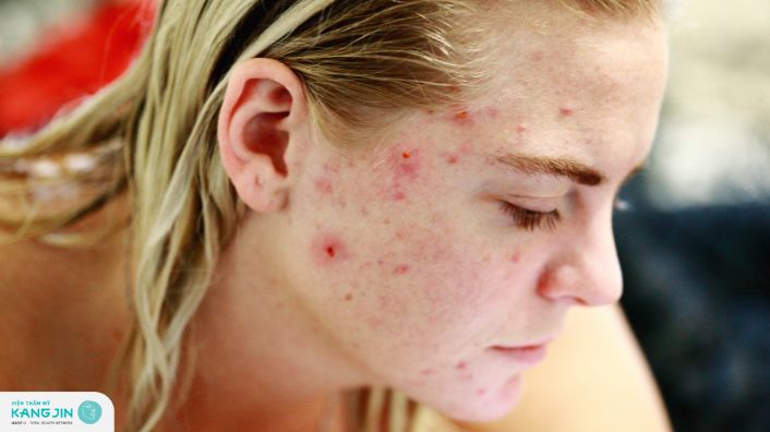 10 Cách chăm sóc da mụn mùa hè không tái phát trở lại