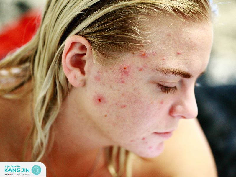 Cách chăm sóc da mụn mùa hè để mụn không tái phát lại