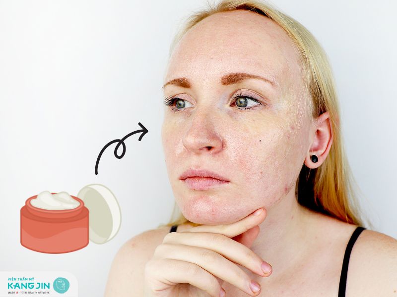 Top kem dưỡng ẩm cho da dầu mụn mùa hè hiệu quả tại nhà 