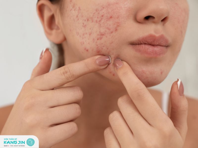 Nặn mụn chăm sóc không đúng cách là một nguyên nhân khiến mụn tái phát lại 