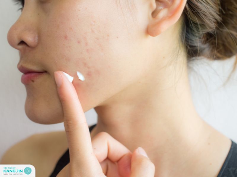 skincare cho da dầu mụn mùa hè