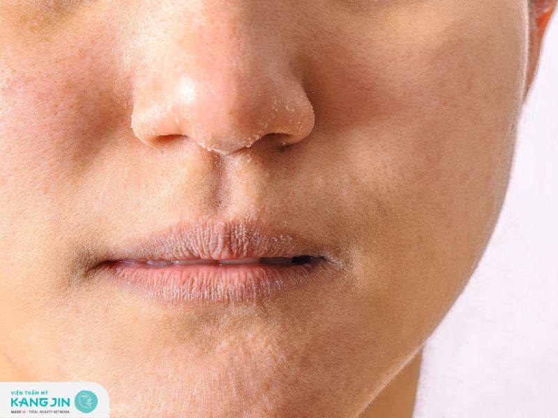 Một số tác hại khi sử dụng kem dưỡng không phù hợp với da hỗn hợp