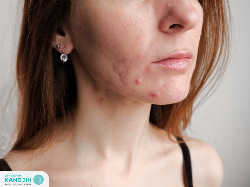 Mụn nhiều bất thường sau khi peel da sai cách