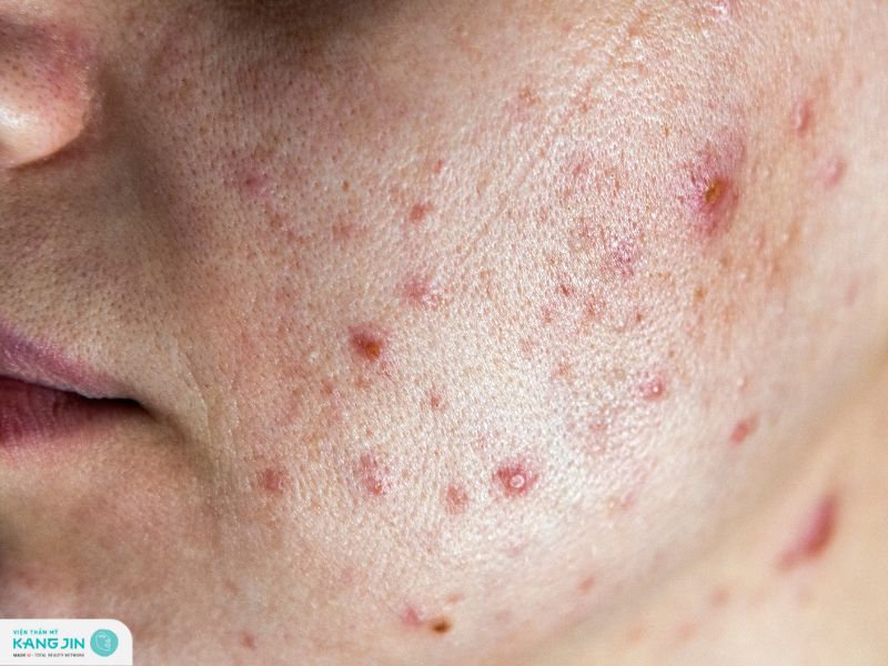 cách làm xẹp mụn sưng đỏ sau 1 đêm