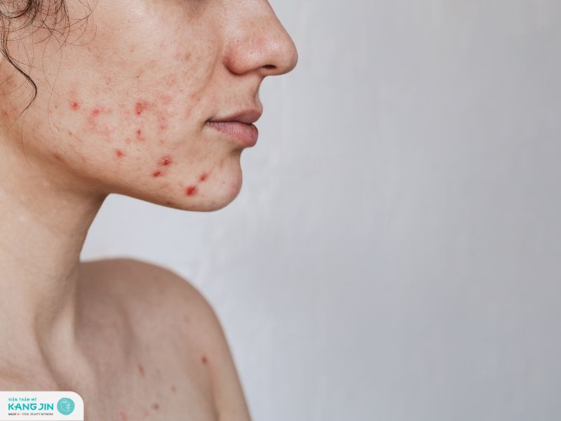 cách làm xẹp mụn sưng đỏ sau 1 đêm