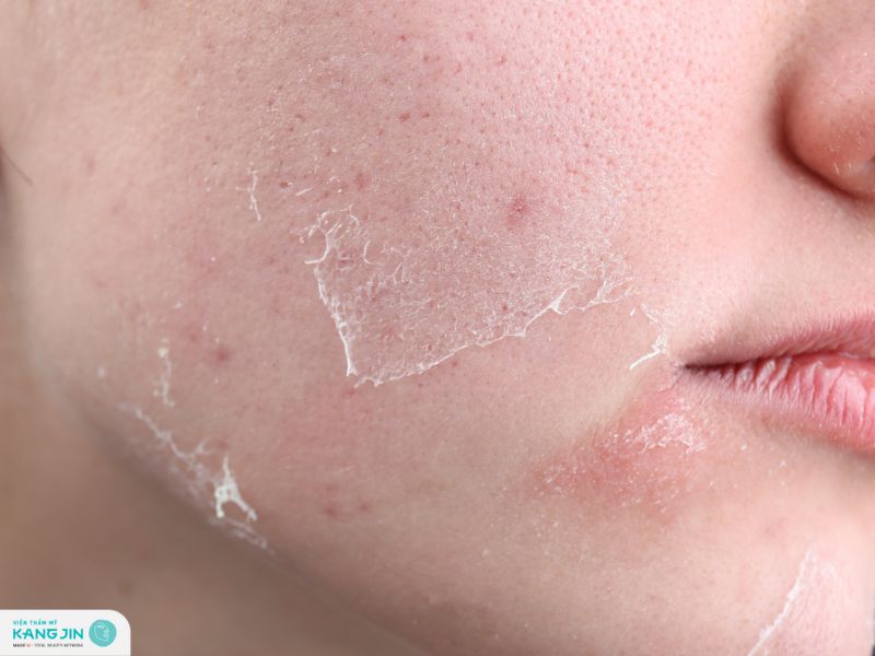 da mỏng có peel được không