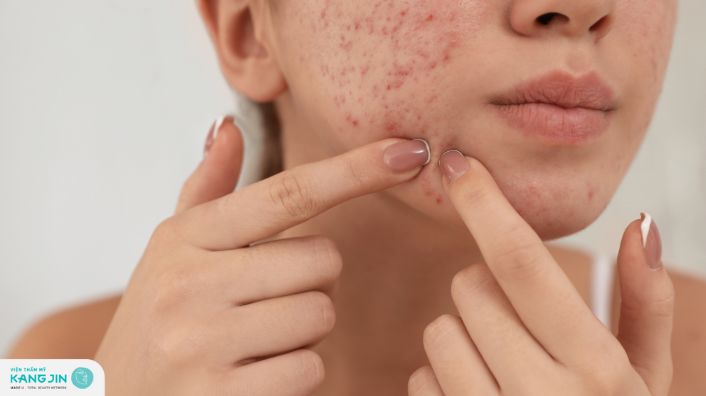 Góc giải đáp: Da mụn có nên peel da không?