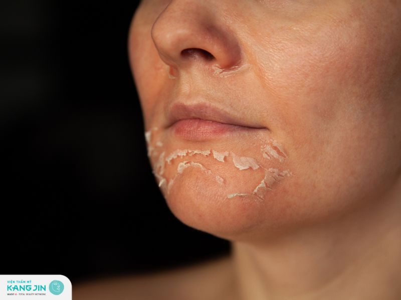 da mụn có nên peel da