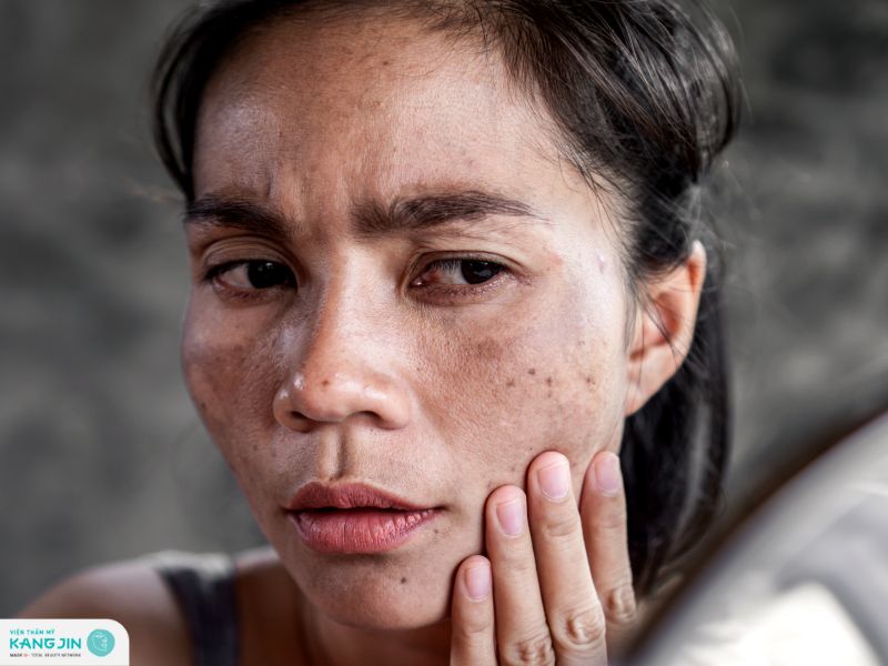 da nám có nên peel da không