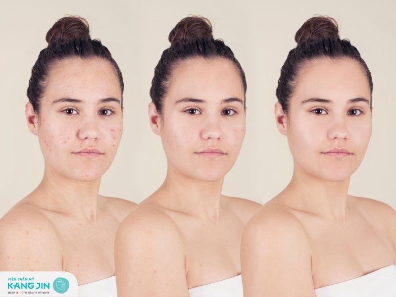 Giảm mụn nhờ Peel da retinol