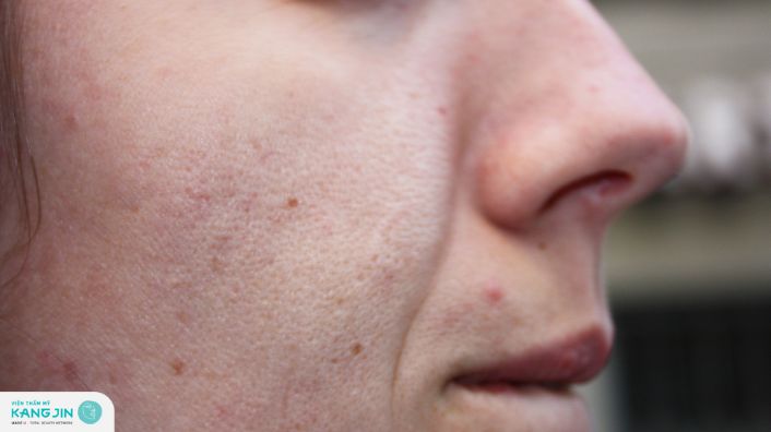 Lỗ chân lông to có nên peel da không?