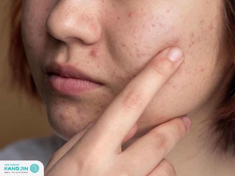 Nguyên nhân gây mụn ẩn và cách điều trị hiệu quả 