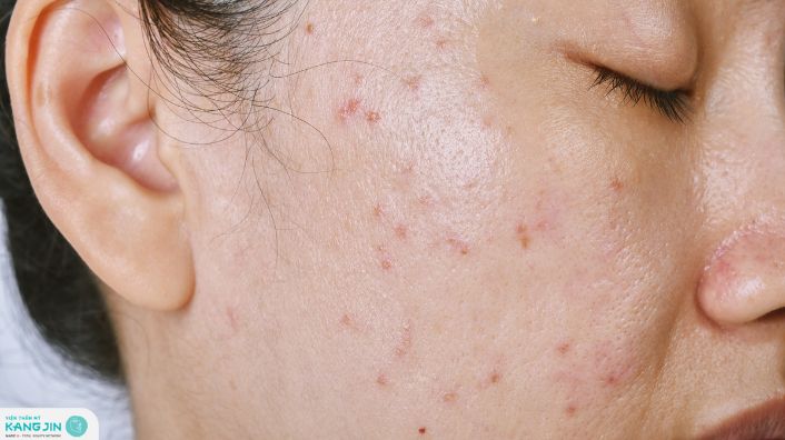 nguyên nhân gây mụn ẩn