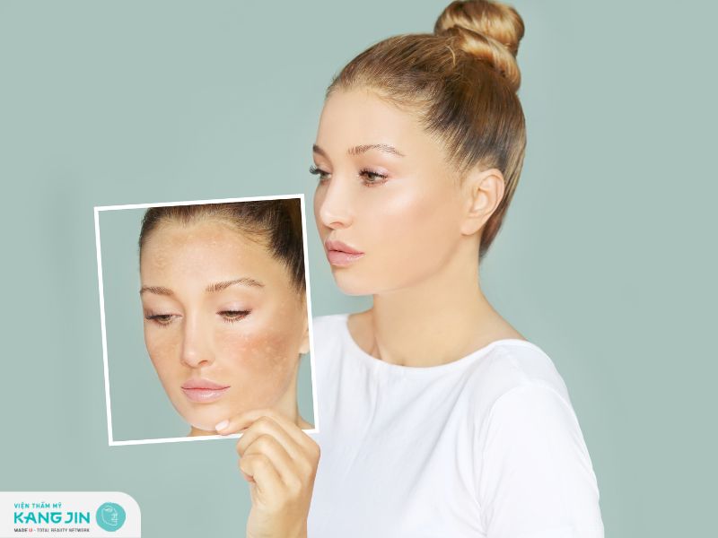 Nguyên nhân và cách khắc phục sau khi peel da bị thâm