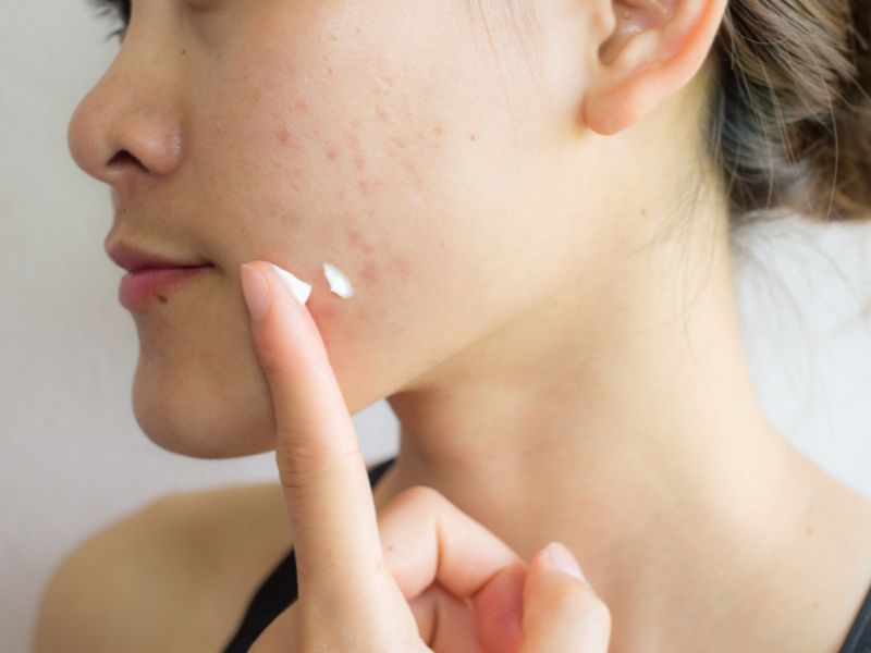 Trị mụn ẩn bằng AHA và dưỡng ẩm da hiệu quả 