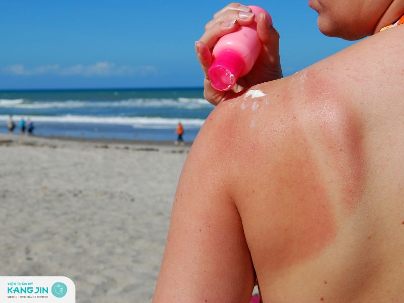 Cách điều trị da bị cháy nắng kịp thời 