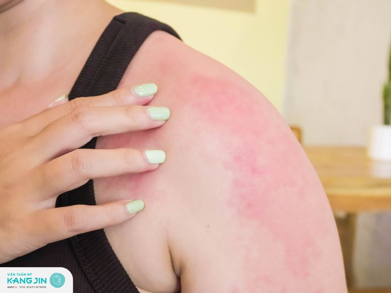 Da nhạy cảm có thể dẫn đến tình trạng sưng viêm