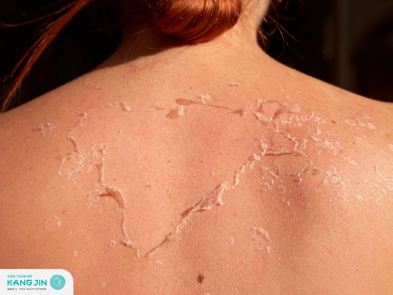 Da bị cháy nắng thường bong tróc gây khó khăn khi sử dụng các sản phẩm chăm sóc da 