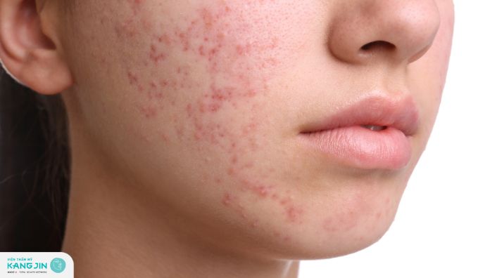 Cách trị da mặt sần sùi nhiều mụn cám mềm mịn không tì vết