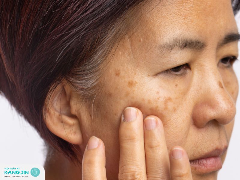 Da mất sự đều màu và thâm sạm là một trong những dấu hiệu lão hóa da 