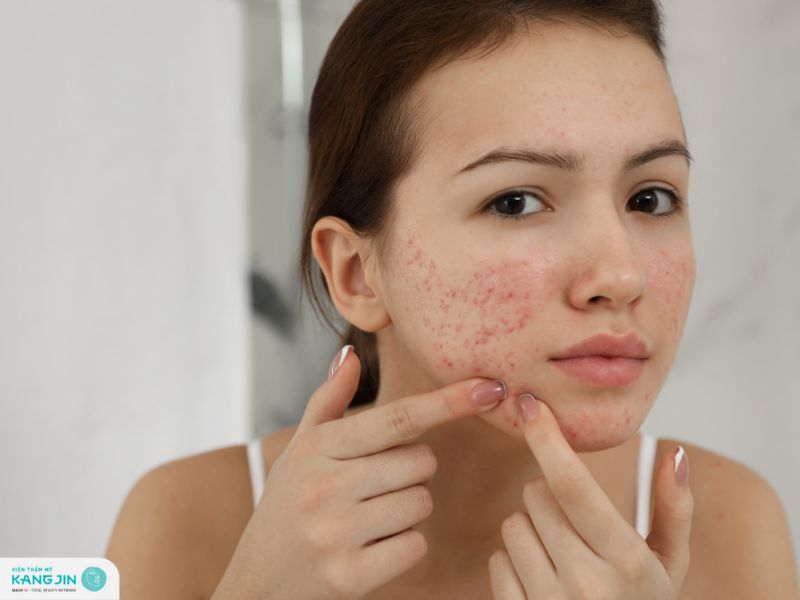 mụn thâm tụ máu có tự hết không