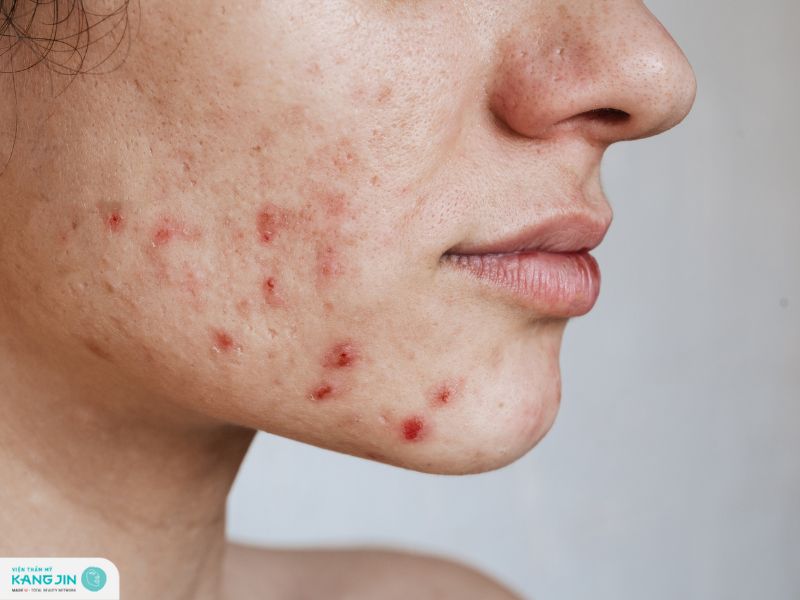 mụn thâm tụ máu có tự hết không