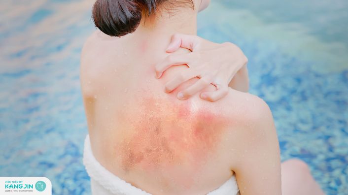 Mẹo phục hồi da bị cháy nắng hiệu quả sau 3 ngày