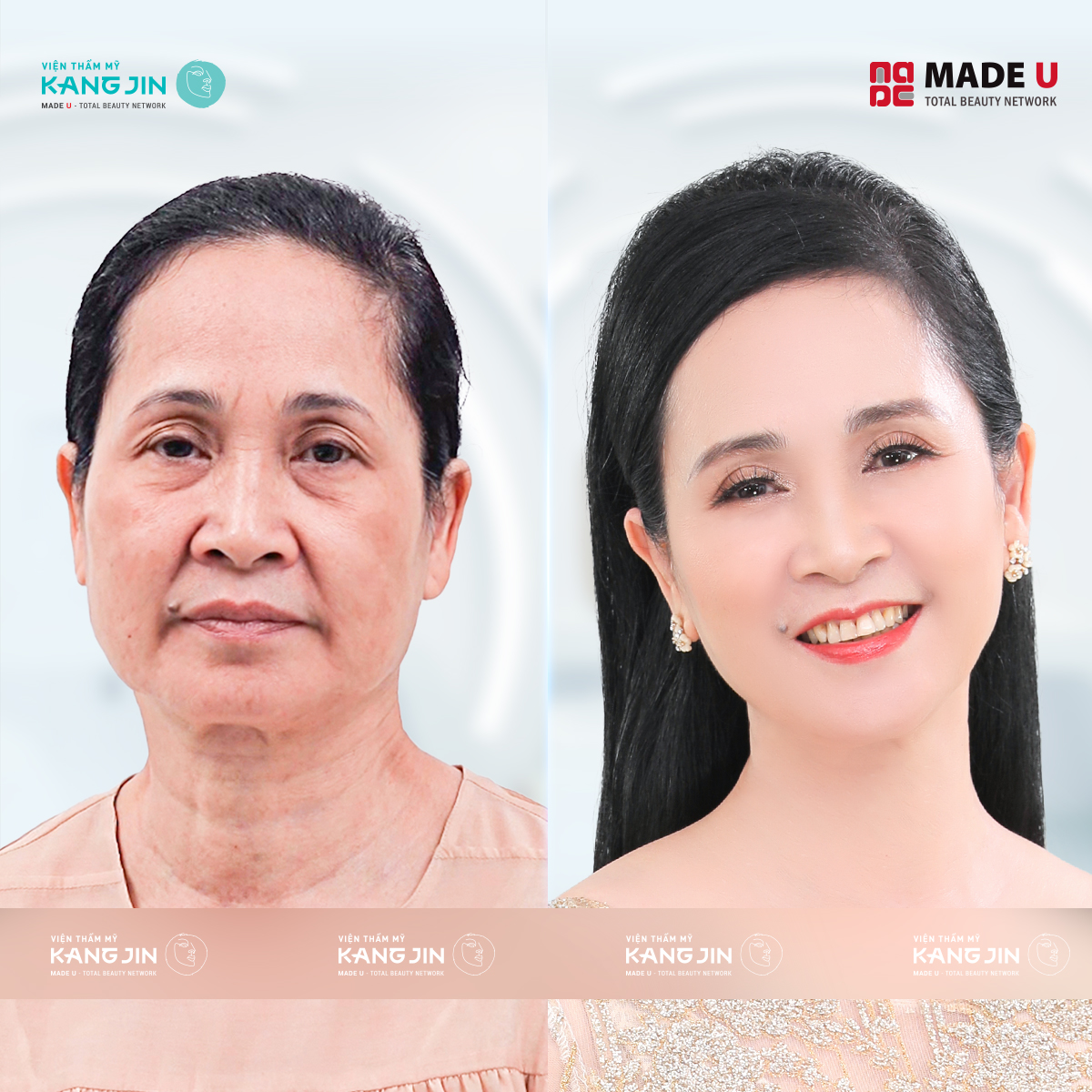 Thực hiện trẻ hóa da bằng liệu pháp KangJin Maxcollagen Diamond Siêu Vi Điểm với NSND Lan Hương 