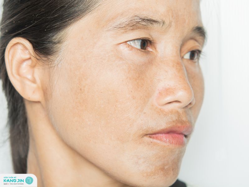 bôi retinol bị sạm da