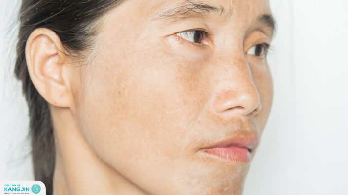 bôi retinol bị sạm da